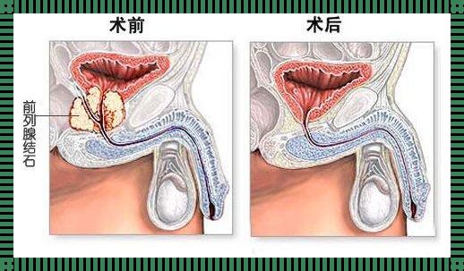 男人前列腺结石怎么治疗