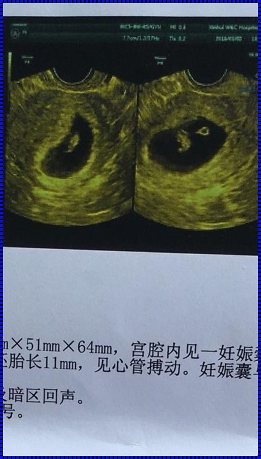 孕囊着床7周位置移动了：关注与关怀