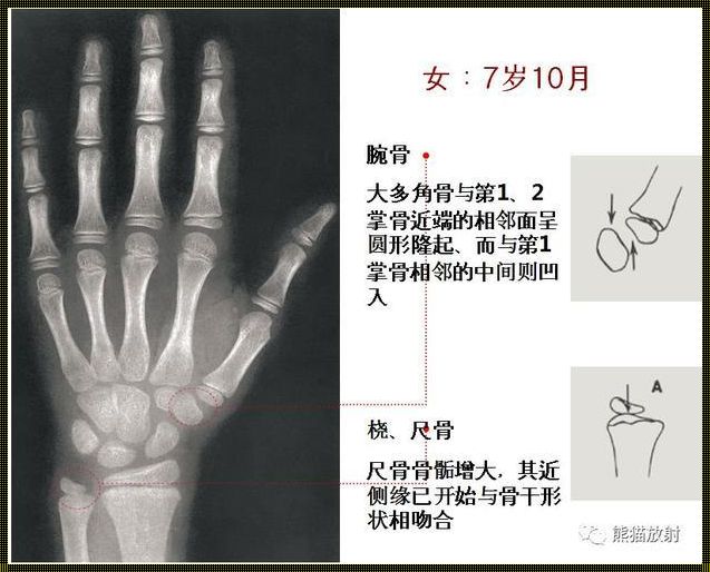 骨化中心8枚是几岁骨龄