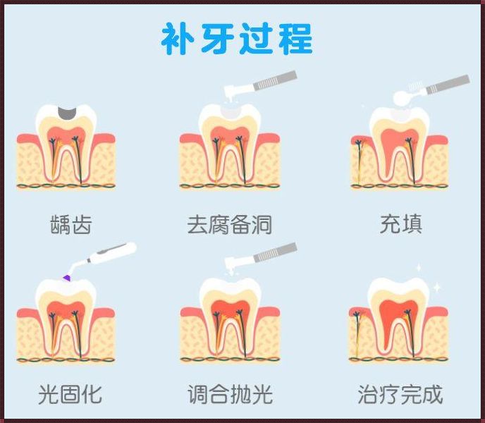 15岁补牙有什么危害？解读青少年补牙注意事项