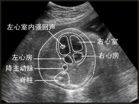 40周左心室强光点还在：探寻心脏健康之谜