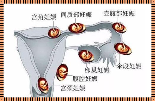 正常怀孕和宫外孕的区别