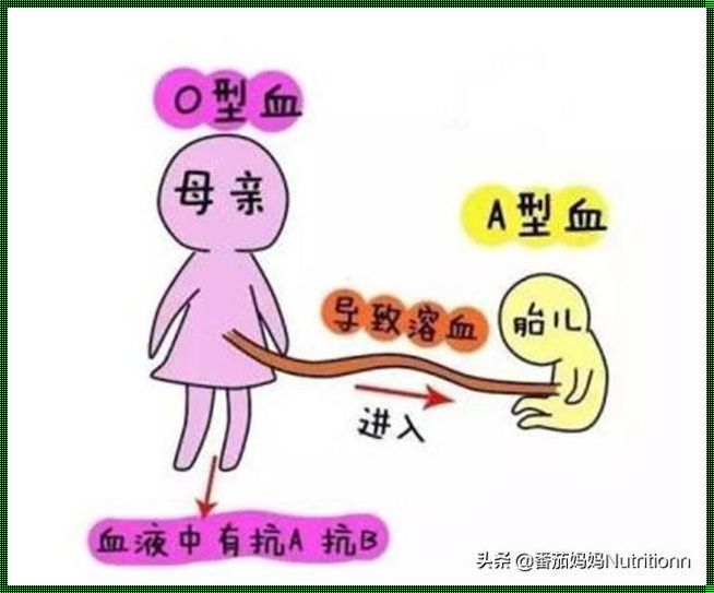 新生儿ABO溶血性黄疸：严重性的探讨与关爱