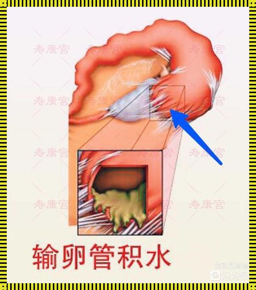 输卵管积水怎样才能消除积水