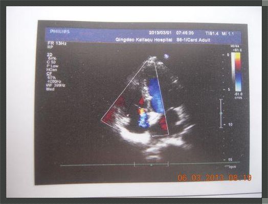 四维彩超胎儿三尖瓣少量反流：爱的监护与期待