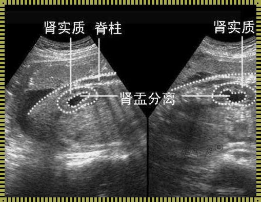 彩超和B超哪个更准确？揭秘