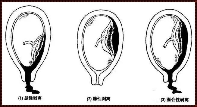 怀孕34周可以打掉孩子吗？——一个深入探讨