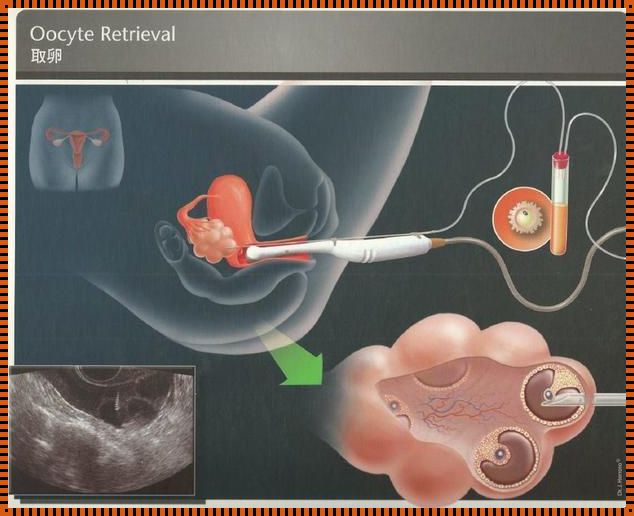 试管婴儿怎样取卵视频：探秘生命之初的奇妙旅程