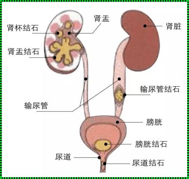 结石卡在小便末端口怎么最快出来？