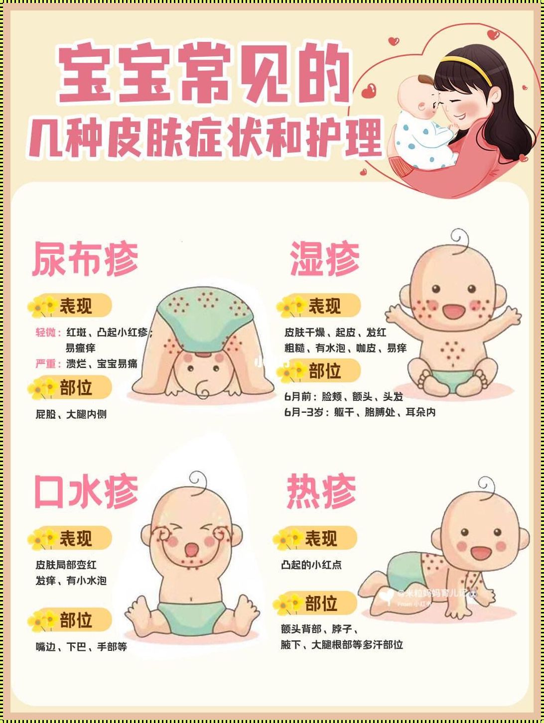 婴儿湿疹怎么处理最好办法