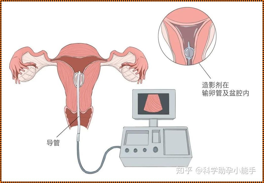 怎样知道自己输卵管是否正常