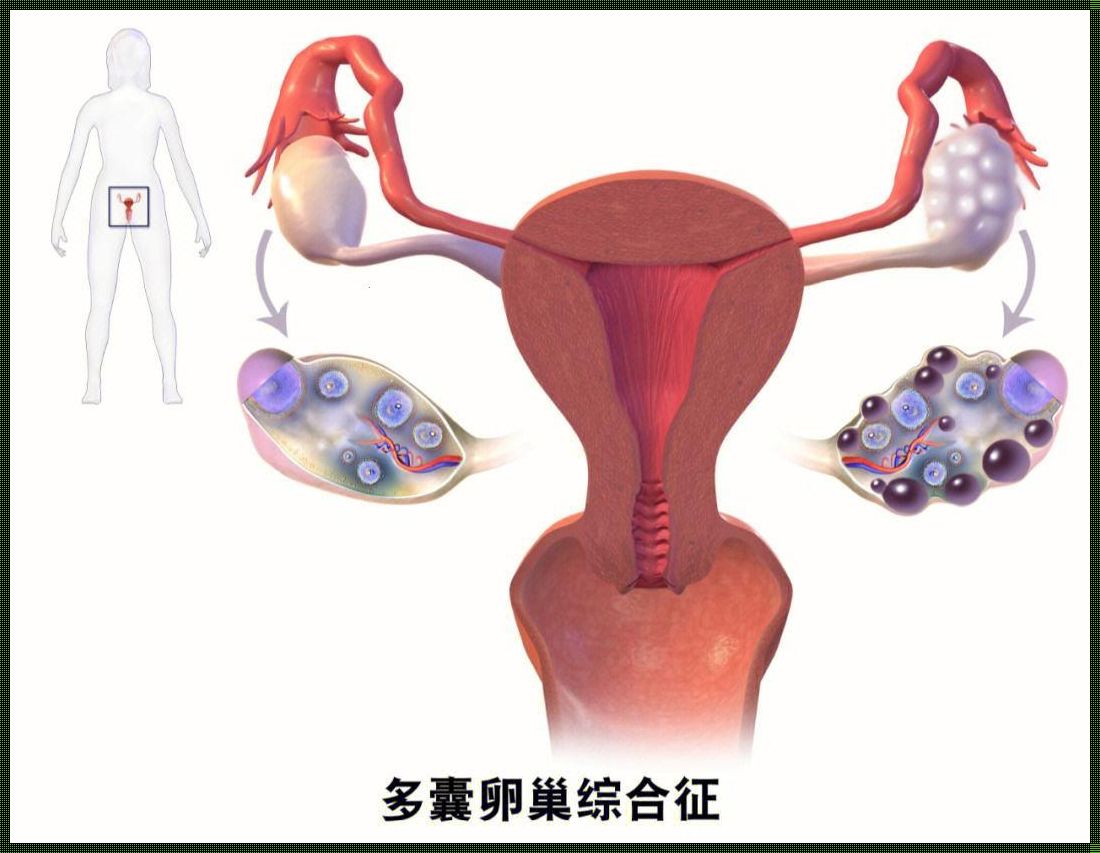 多囊卵巢能怀上孩子吗？