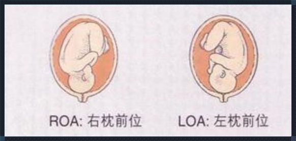 探讨胎方位LOA的合理性