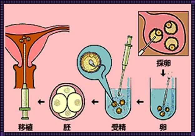 移植是把胚胎放入子宫吗？——深入探究生育医疗过程