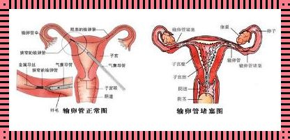 两边输卵管堵塞还可以怀孕吗？