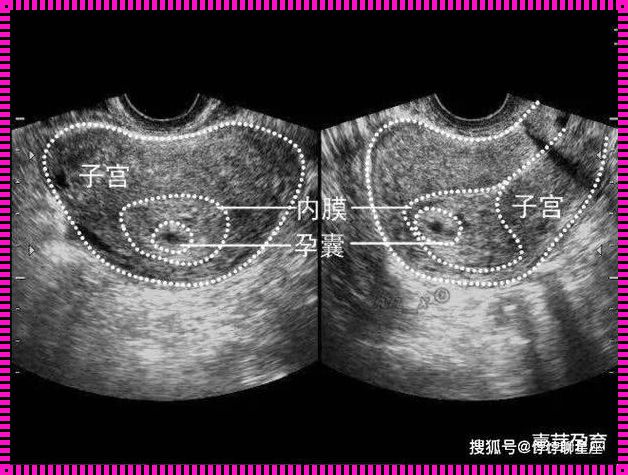 怀孕40天hcg300多无孕囊：一场与生命的等待与期待