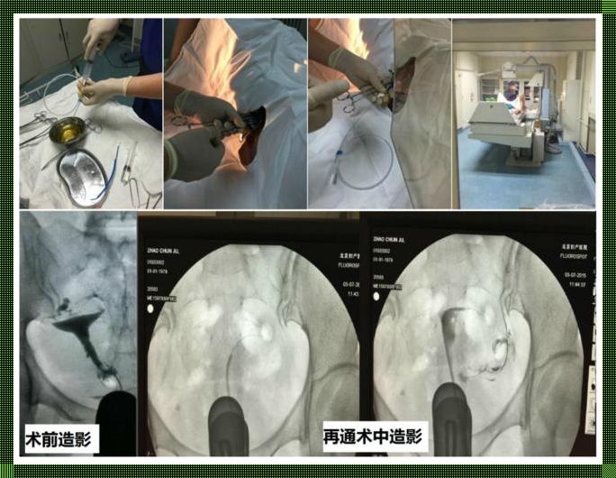 备孕必须做输卵管造影吗？揭开这神秘的面纱