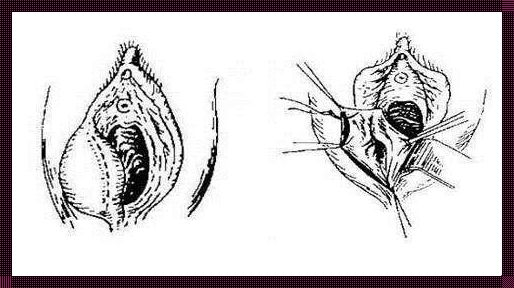 女性巴氏腺囊肿成熟图揭秘：探讨性别健康话题