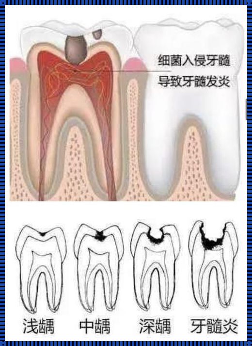 儿童杀完牙神经后半夜疼正常吗？