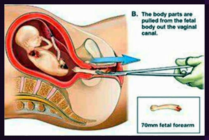 孕12周做引产手术过程：一种理性的选择