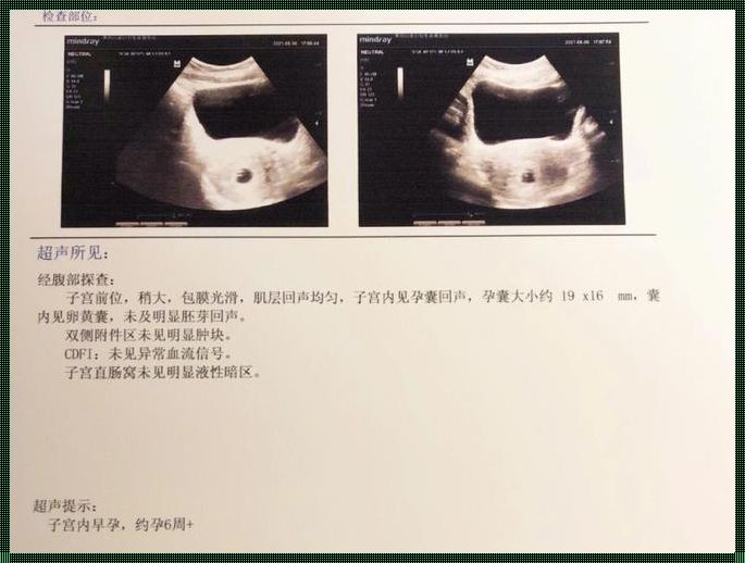 孕18周胎停前其实有暗示信号