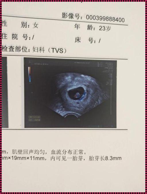 6周一个孕囊还会双胞胎吗