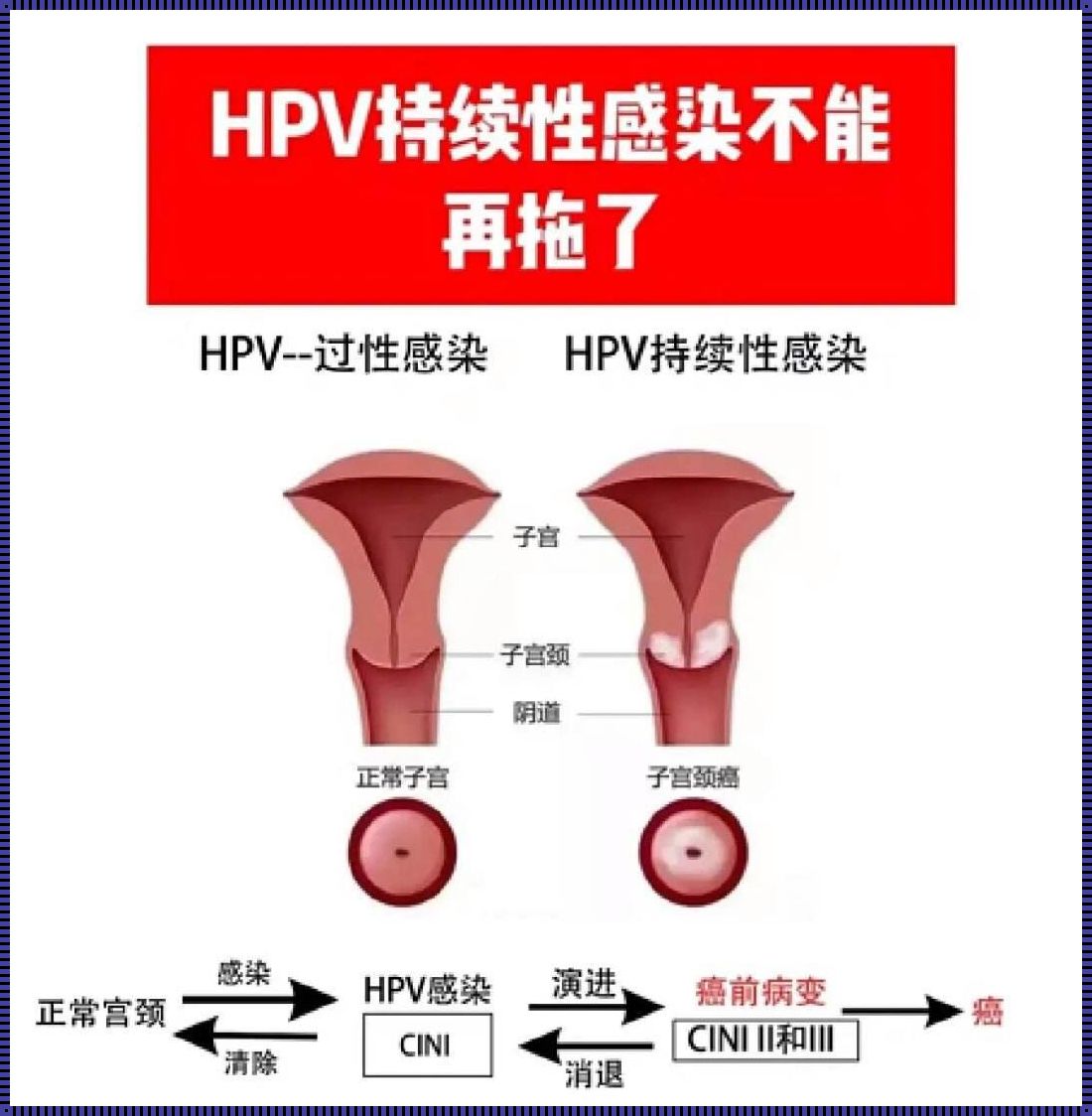 HPV感染真相：如何预防与应对