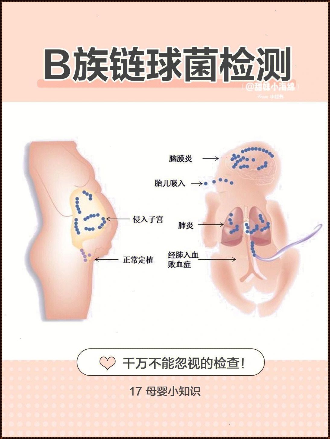 B族链球菌感染与顺产争议：安全风险谁来买单？