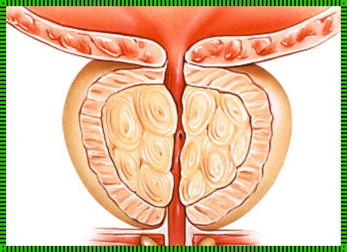 前列腺出血是怎么回事