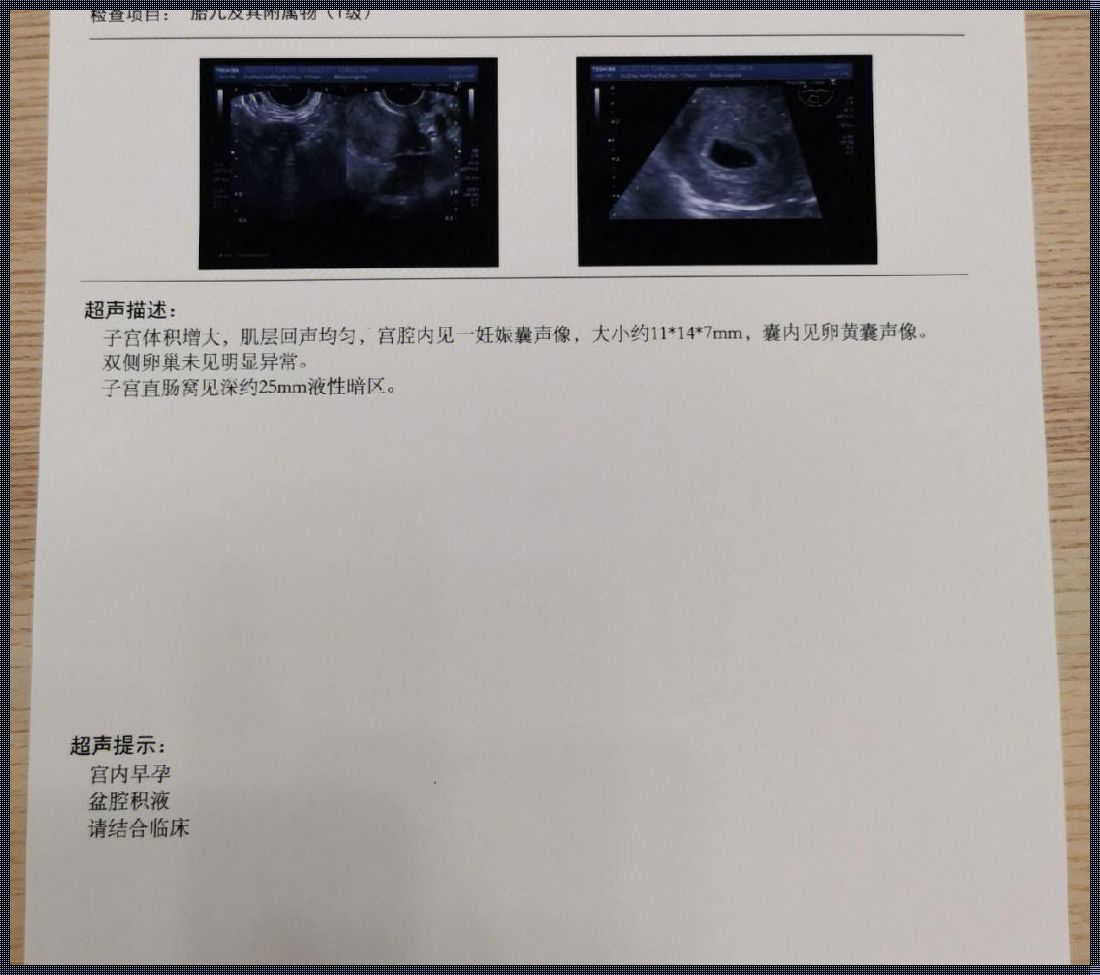 刚怀孕怎么确定是宫内孕：深入了解宫内孕的神秘面纱