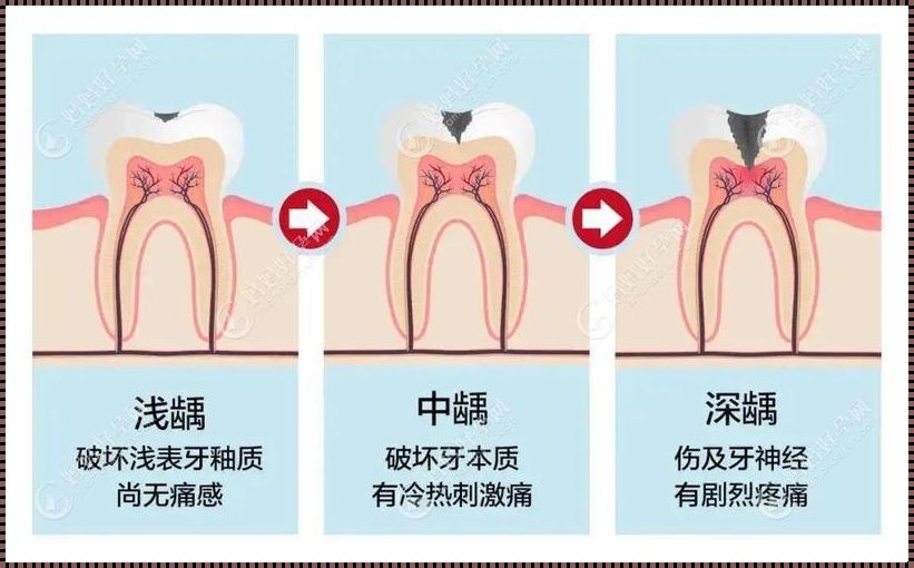 轻微蛀牙为什么不建议补