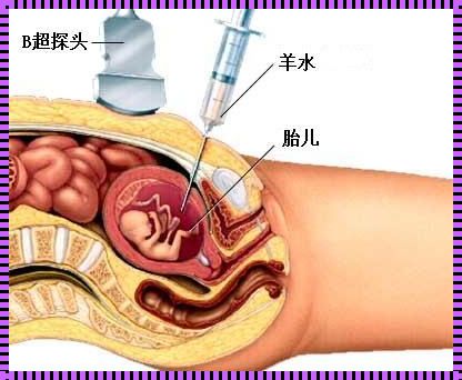 30周做羊水穿刺的经历：在未知与了解之间搭建桥梁