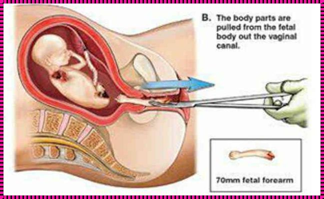 三个半月引产流程：解读生命之旅的转折