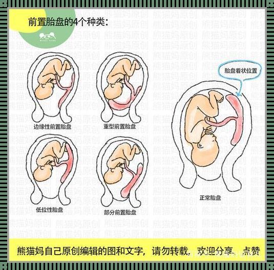 35周胎盘一级好还是二级好：深入了解胎盘等级的含义