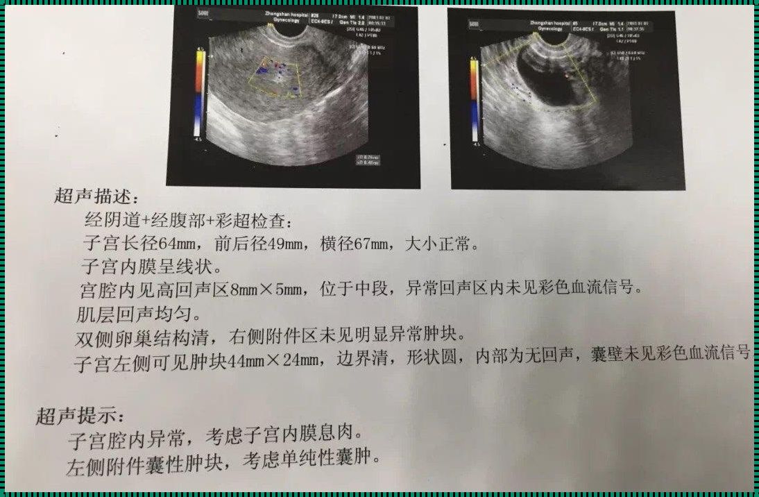 子宫内膜息肉拖久了会怎么样？揭秘其潜在影响