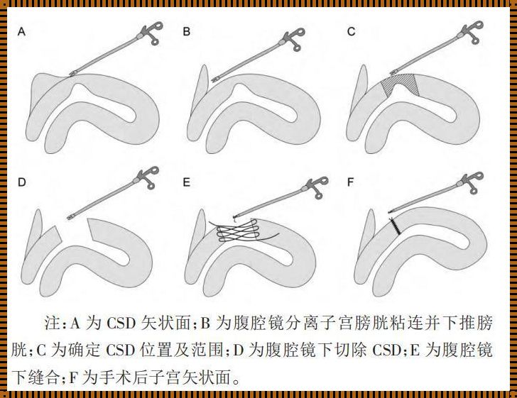 子宫疤痕憩室手术治疗效果探析