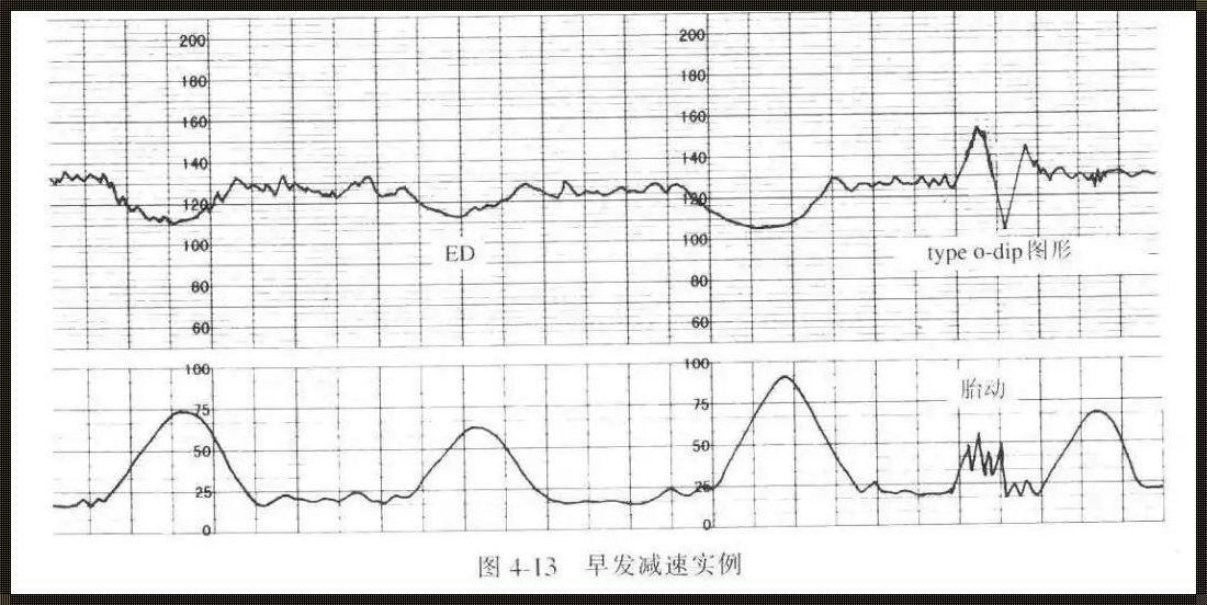 揭秘胎心监护：三种减速现象及其深层意义