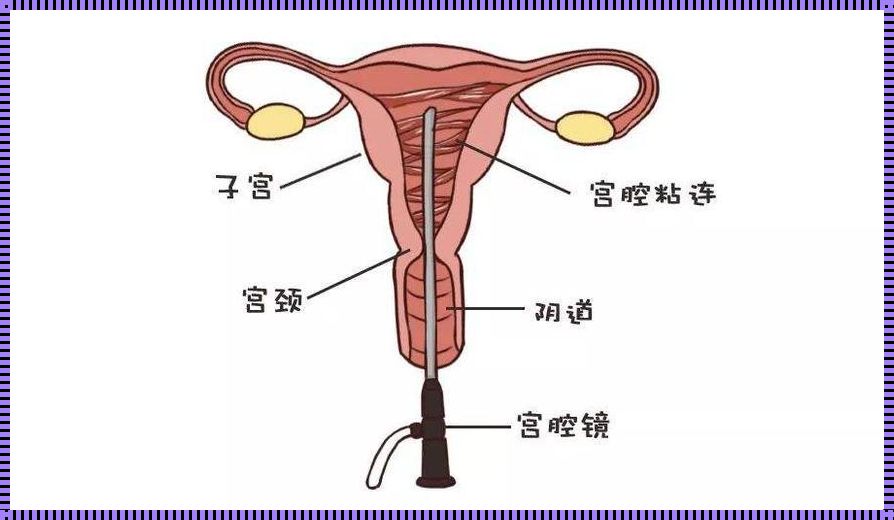 怀孕了宫腔粘连会好吗