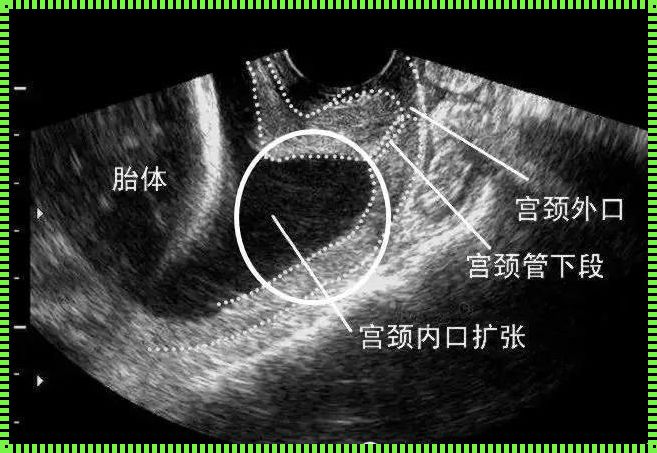 孕31周宫颈内口开了，我们应该如何看待这个问题？