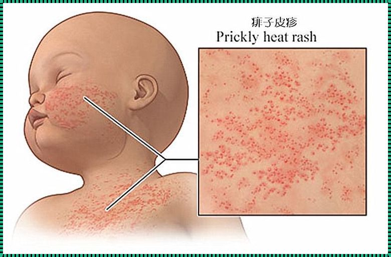 热痱子终结者：夏日清爽的秘密武器