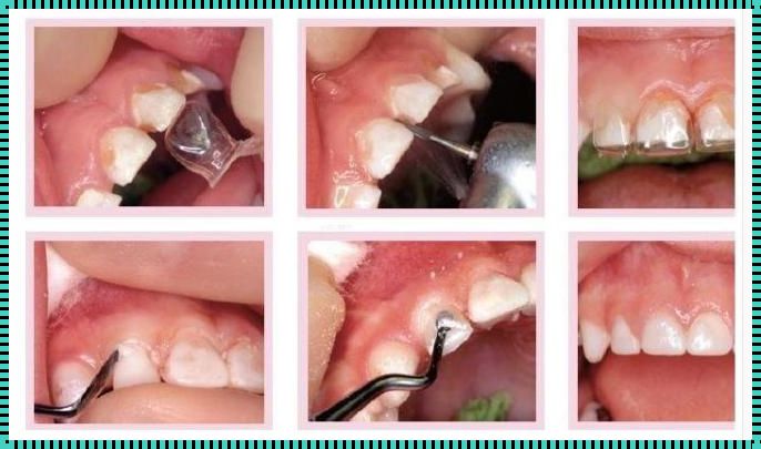 儿童补牙是否需要打麻药？专家告诉你答案