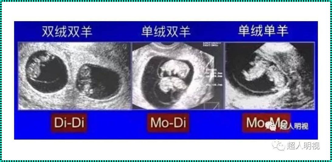 为什么16周才发现双胎——一位母亲的内心独白