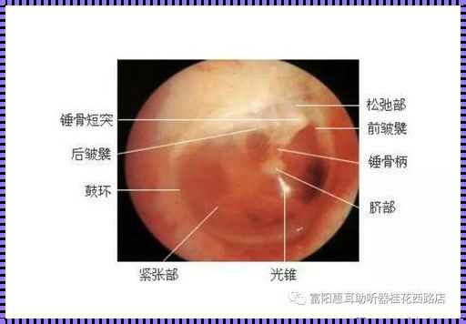 耳膜穿孔：听见未来的可能