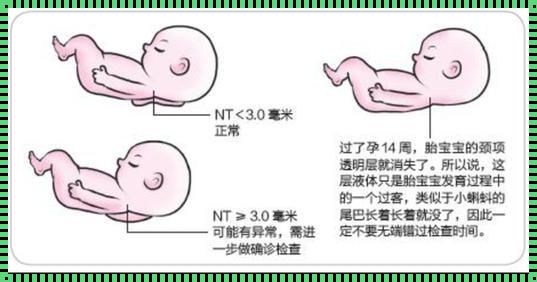 胎儿NT厚度达第95百分位数：共同面对挑战