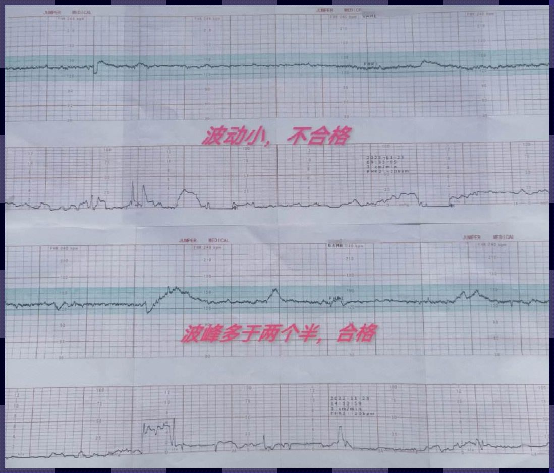 孕晚期胎心监护不过关怎么办？——守护宝宝健康的探究之旅