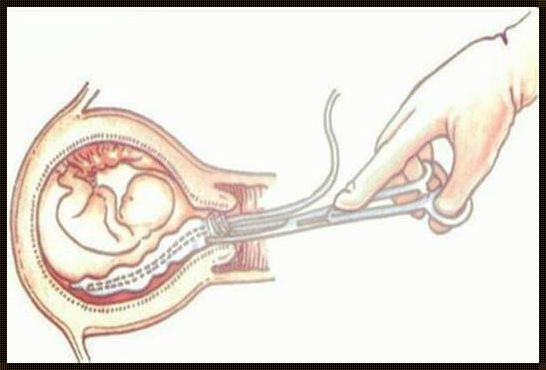 怀孕生下来和引产哪个更伤身体？一位医生的深刻见解