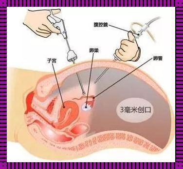 宫外孕怎么处理：寻觅生命的答案