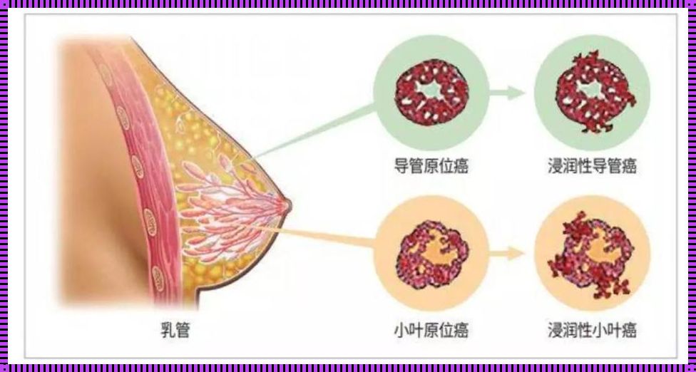 乳头出血，乳腺癌的警示信号？