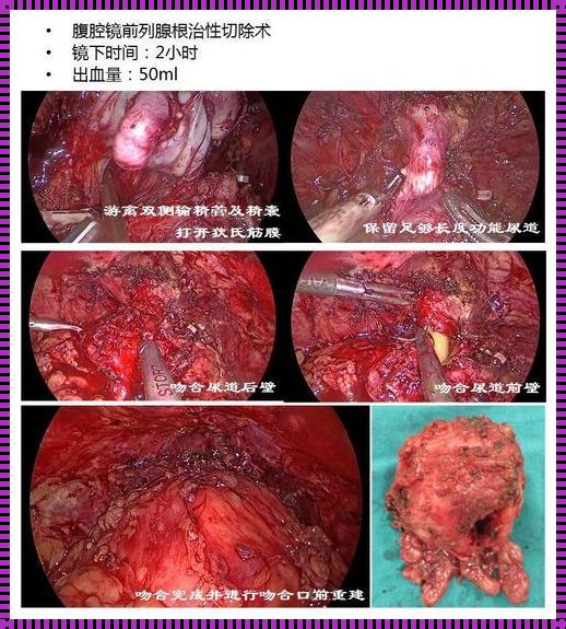 前列腺癌18年了：一位幸存者的故事