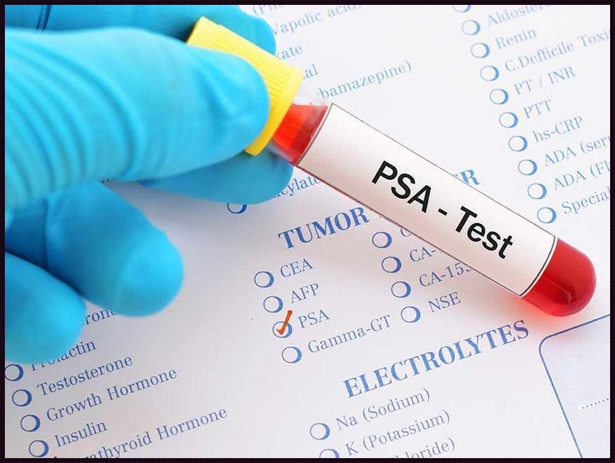 PSA三个月内从30降到正常的奇迹